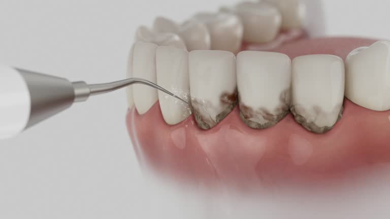 Trusted Wisdom Tooth Removal service in Tuscaloosa, AL - Dentist Open Now